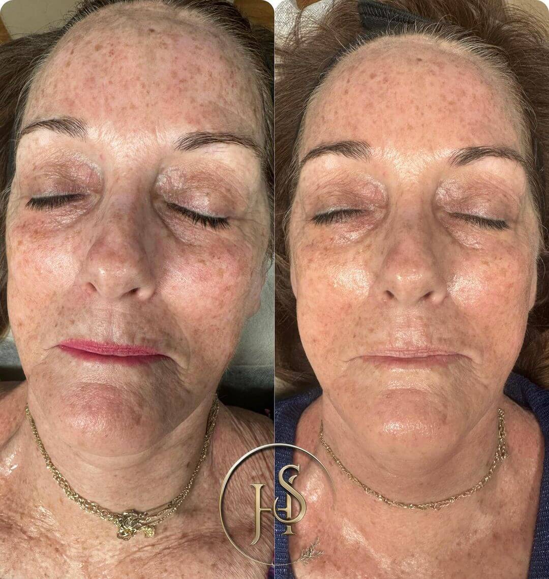 Experience Expert Facial Rejuvenation and Skin Care in Plano with Shahina Hoja